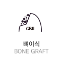 뼈이식 bone graft